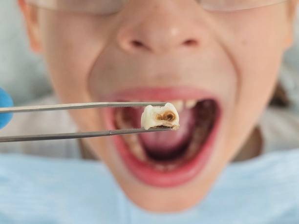 Urgent Tooth Repair in IA